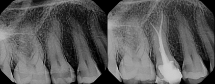 Laser Endodontic Root Canals | Root Canal Dentist | Philadelphia Dentist