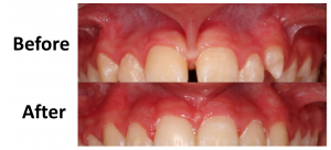 Frenectomy Laser Treatment | Philadelphia Dentist